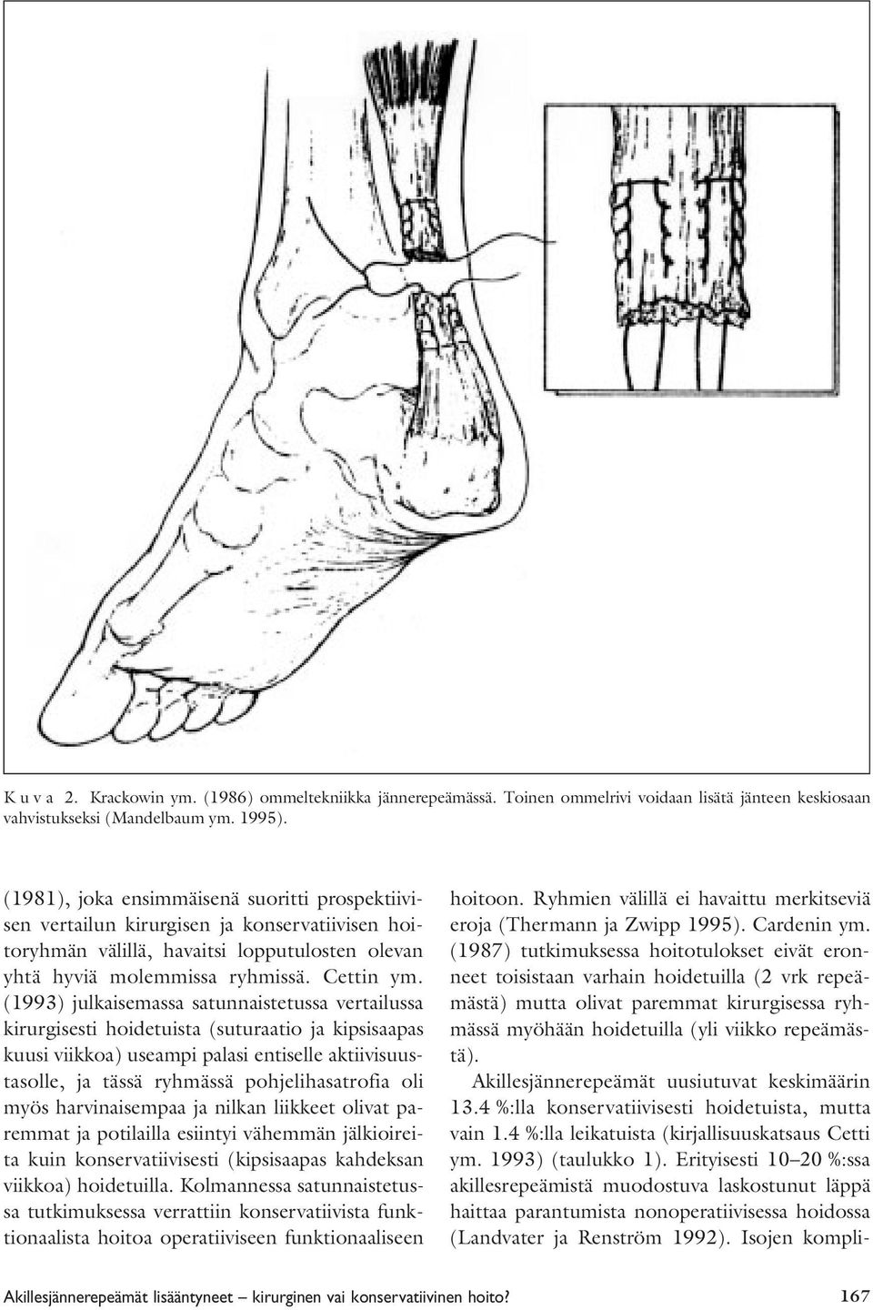 (1993) julkaisemassa satunnaistetussa vertailussa kirurgisesti hoidetuista (suturaatio ja kipsisaapas kuusi viikkoa) useampi palasi entiselle aktiivisuustasolle, ja tässä ryhmässä pohjelihasatrofia