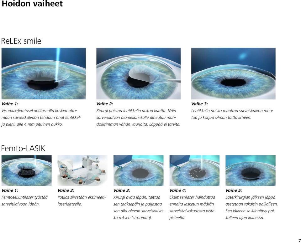 Vaihe 3: Lentikkelin poisto muuttaa sarveiskalvon muotoa ja korjaa silmän taittovirheen. Femto-LASIK Vaihe 1: Femtosekuntilaser työstää sarveiskalvoon läpän.