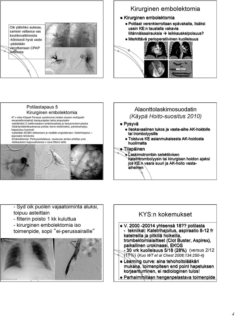 l Merkittävä perioperatiivinen kuolleisuus Potilastapaus 5 Kirurginen embolektomia 47 v mies Klippel-Trenaue syndrooma (reiden alueen multippelit venamalformaatiot) kampurajalan takia amputaatio -