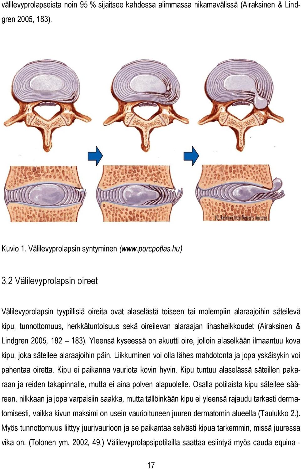 lihasheikkoudet (Airaksinen & Lindgren 2005, 182 183). Yleensä kyseessä on akuutti oire, jolloin alaselkään ilmaantuu kova kipu, joka säteilee alaraajoihin päin.