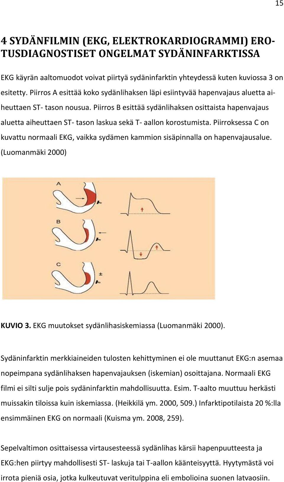 Piirros B esittää sydänlihaksen osittaista hapenvajaus aluetta aiheuttaen ST- tason laskua sekä T- aallon korostumista.