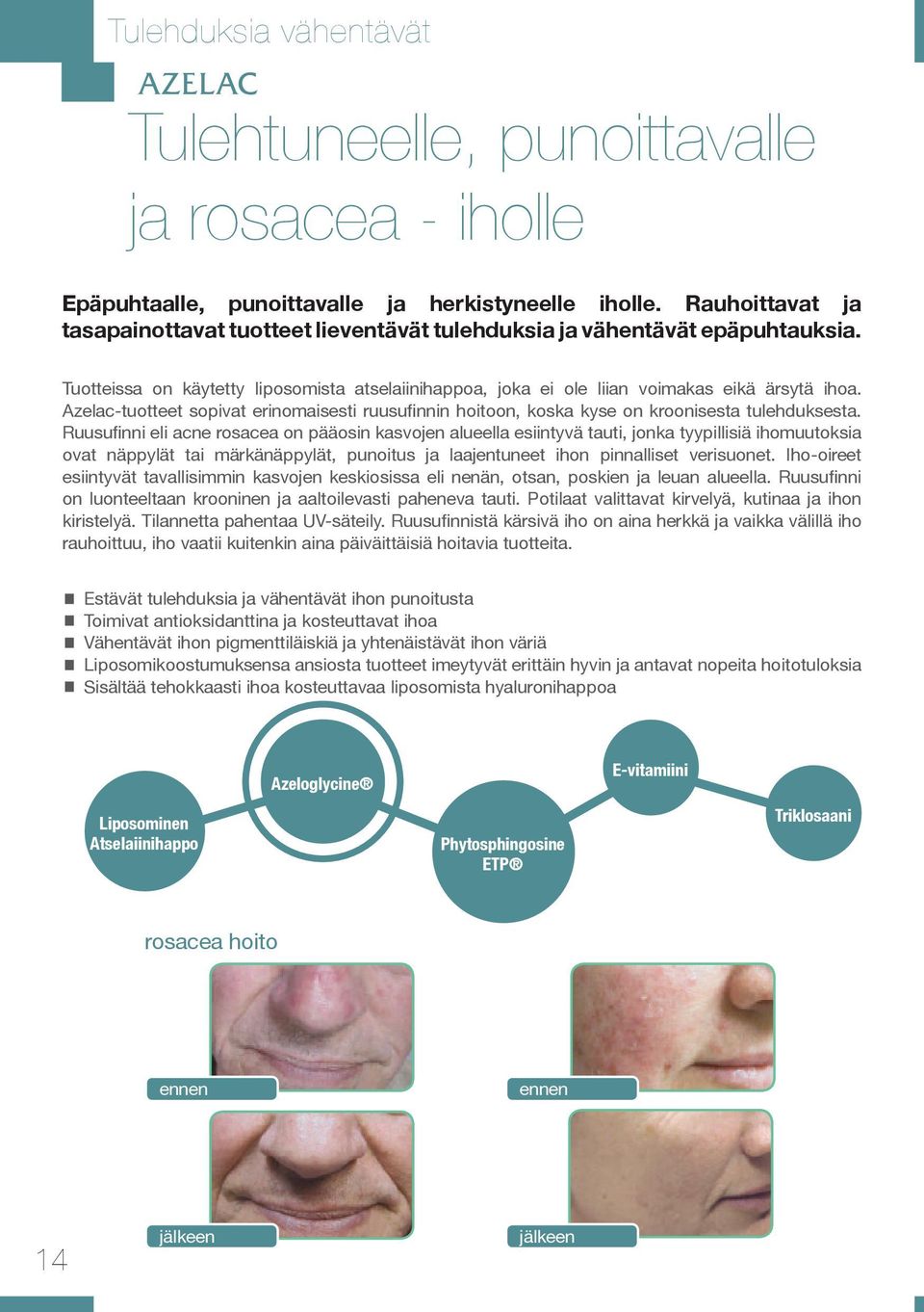 Azelac-tuotteet sopivat erinomaisesti ruusufinnin hoitoon, koska kyse on kroonisesta tulehduksesta.