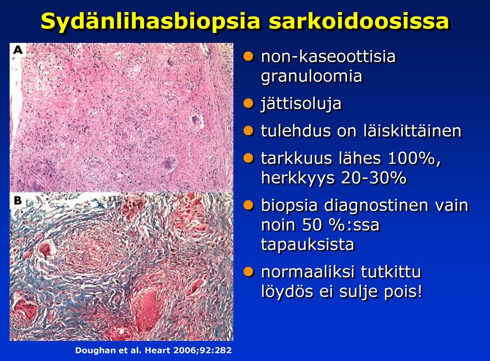 herkkyys 20-30% biopsia diagnostinen vain noin 50 %:ssa