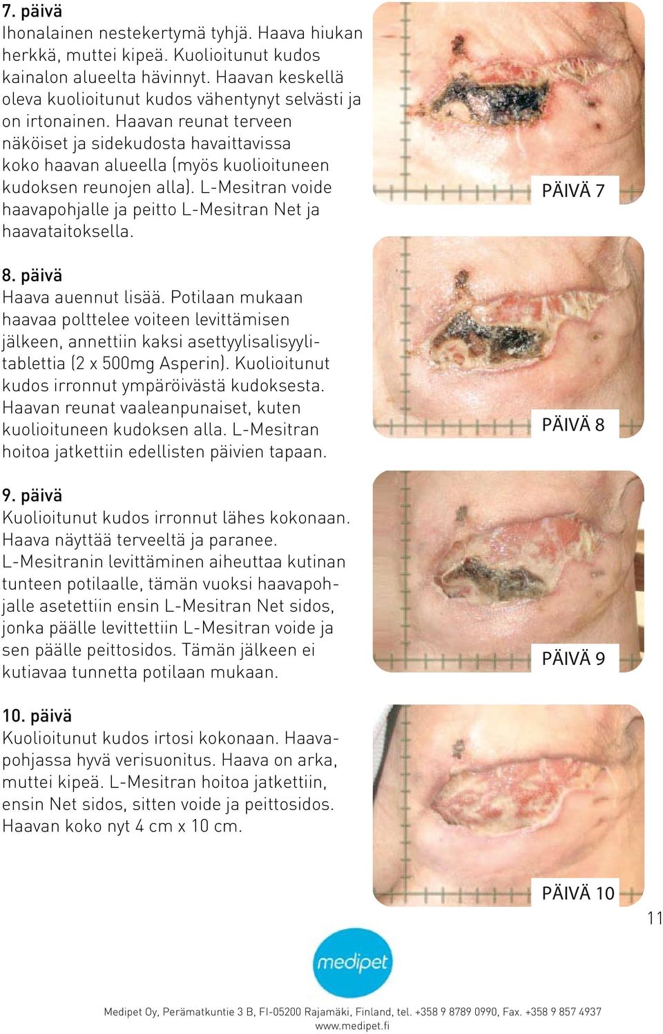 Haavan reunat terveen näköiset ja sidekudosta havaittavissa koko haavan alueella (myös kuolioituneen kudoksen reunojen alla).