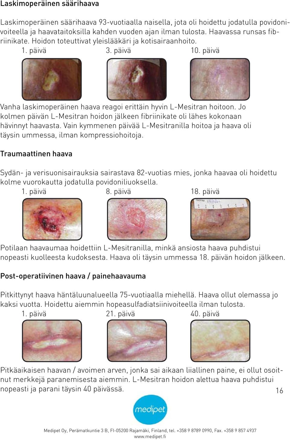 Jo kolmen päivän L-Mesitran hoidon jälkeen fibriinikate oli lähes kokonaan hävinnyt haavasta. Vain kymmenen päivää L-Mesitranilla hoitoa ja haava oli täysin ummessa, ilman kompressiohoitoja.