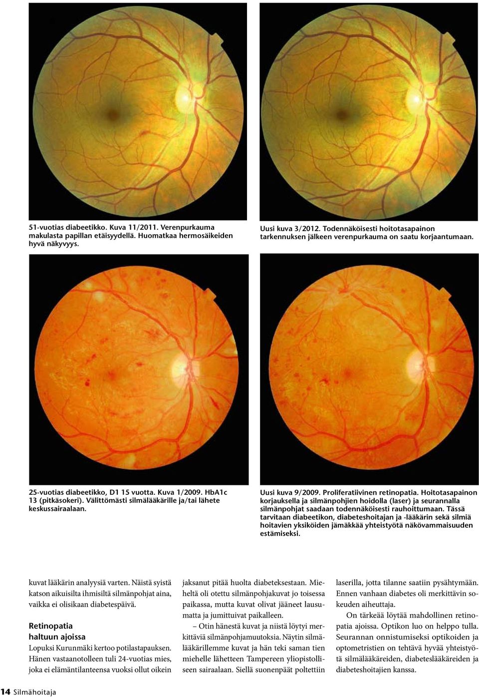 Välittömästi silmälääkärille ja/tai lähete keskussairaalaan. Uusi kuva 9/2009. Proliferatiivinen retinopatia.