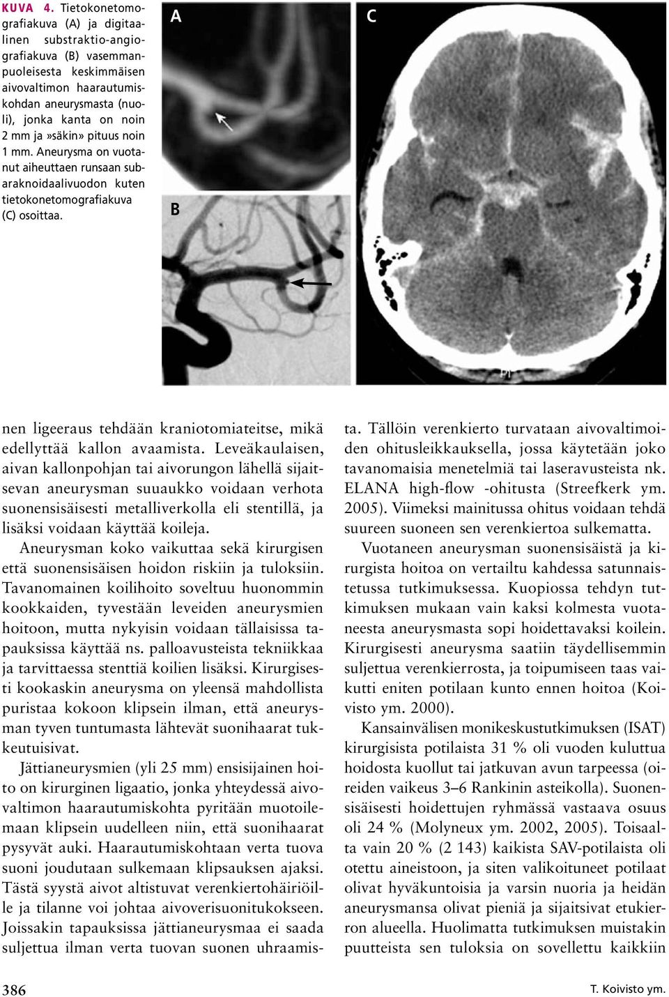 pituus noin 1 mm. Aneurysma on vuotanut aiheuttaen runsaan subaraknoidaalivuodon kuten tietokonetomografiakuva (C) osoittaa.