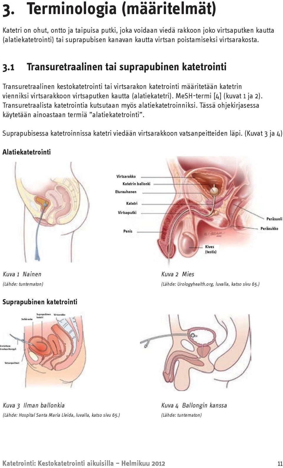 1 Transuretraalinen tai suprapubinen katetrointi Transuretraalinen kestokatetrointi tai virtsarakon katetrointi määritetään katetrin vienniksi virtsarakkoon virtsaputken kautta (alatiekatetri).