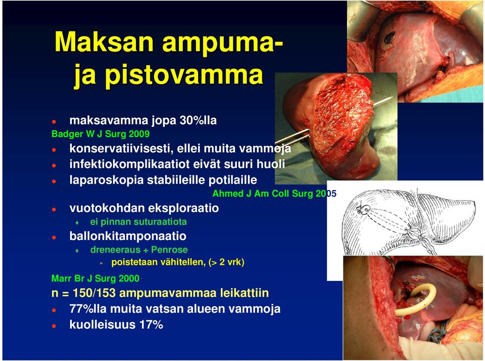 vuotokohdan eksploraatio ei pinnan suturaatiota ballonkitamponaatio dreneeraus + Penrose Marr Br J Surg 2000»