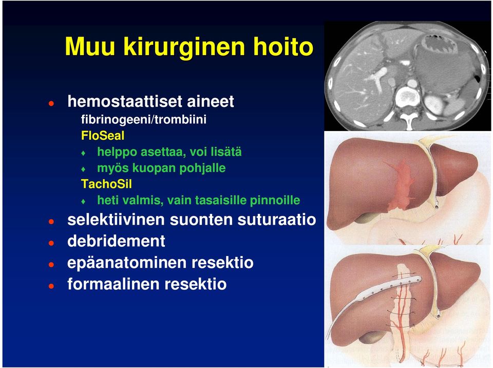 kuopan pohjalle TachoSil heti valmis, vain tasaisille pinnoille