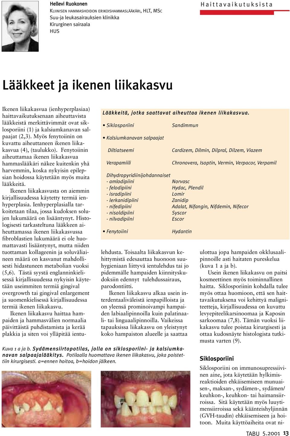 Siklosporiini Kalsiumkanavan salpaajat Diltiatseemi Verapamiili Sandimmun Ikenen liikakasvua (ienhyperplasiaa) haittavaikutuksenaan aiheuttavista lääkkeistä merkittävimmät ovat siklosporiini (1) ja