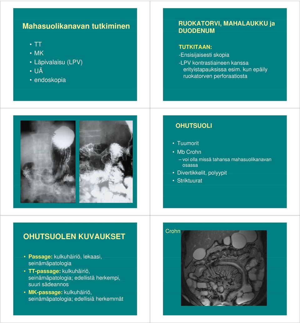 kun epäily ruokatorven perforaatiosta OHUTSUOLI Tuumorit Mb Crohn voi olla missä tahansa mahasuolikanavan osassa Divertikkelit, polyypit