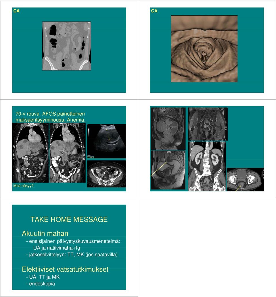 TAKE HOME MESSAGE Akuutin mahan - ensisijainen