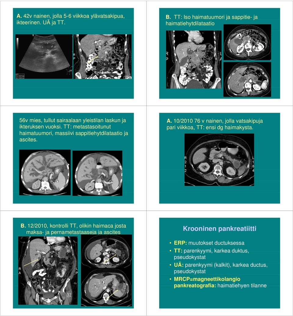 TT: metastasoitunut haimatuumori, massiivi sappitiehytdilataatio ja ascites. A. 10/2010 76 v nainen, jolla vatsakipuja pari viikkoa, TT: ensi dg haimakysta. B.