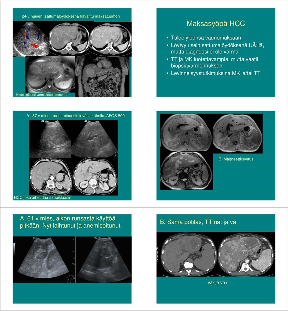 TT Histologisesti varmistettu adenoma A. 57 v mies, transaminaasit lievästi koholla, AFOS 500 B.