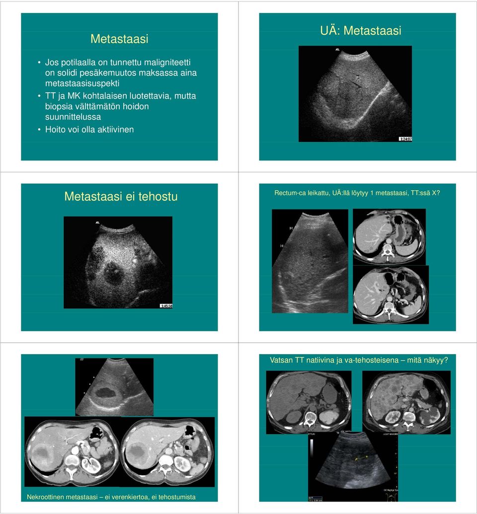 Hoito voi olla aktiivinen Metastaasi ei tehostu Rectum-ca leikattu, UÄ:llä löytyy 1 metastaasi, TT:ssä X?