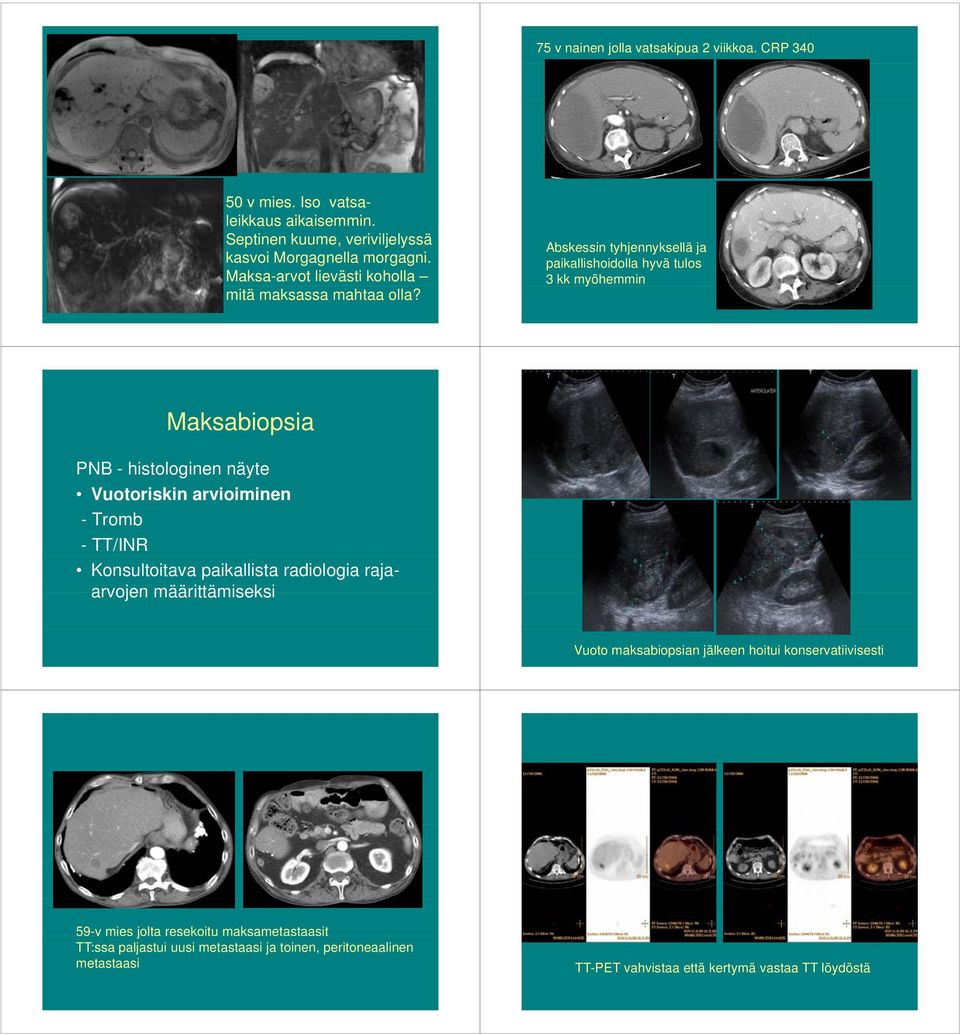 Abskessin tyhjennyksellä ja paikallishoidolla hyvä tulos 3 kk myöhemmin Maksabiopsia PNB - histologinen näyte Vuotoriskin arvioiminen - Tromb - TT/INR