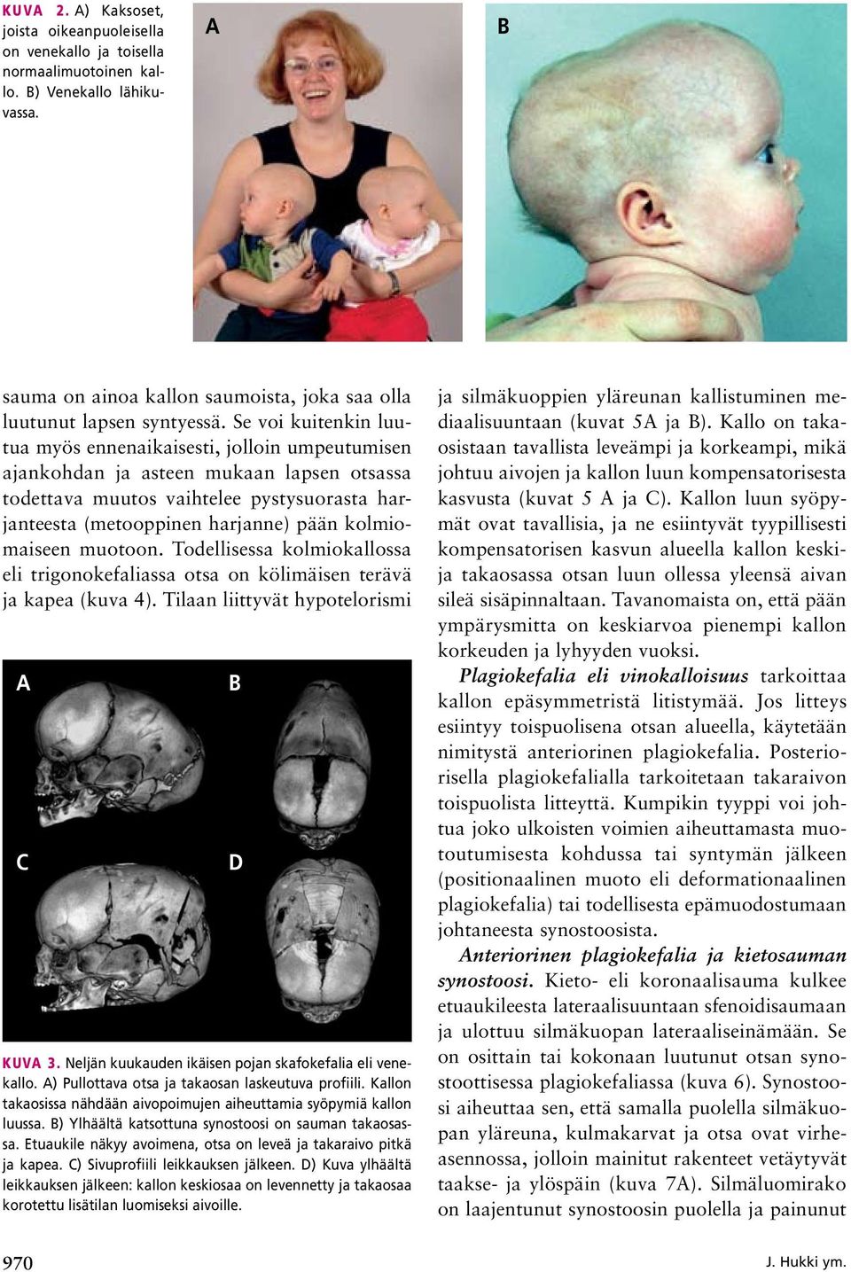 kolmiomaiseen muotoon. Todellisessa kolmiokallossa eli trigonokefaliassa otsa on kölimäisen terävä ja kapea (kuva 4). Tilaan liittyvät hypotelorismi A C KUVA 3.