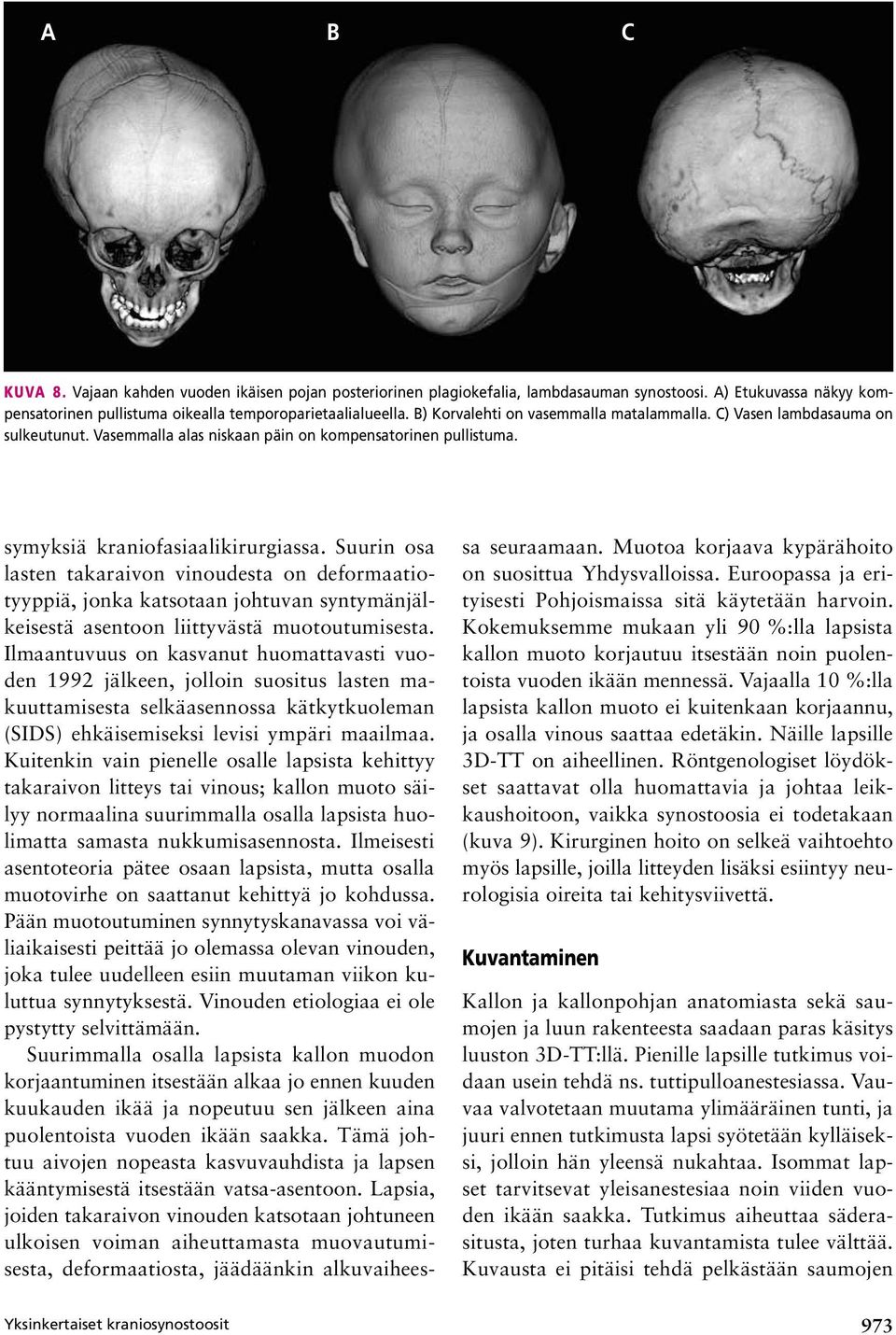 Yksinkertaiset kraniosynostoosit symyksiä kraniofasiaalikirurgiassa.