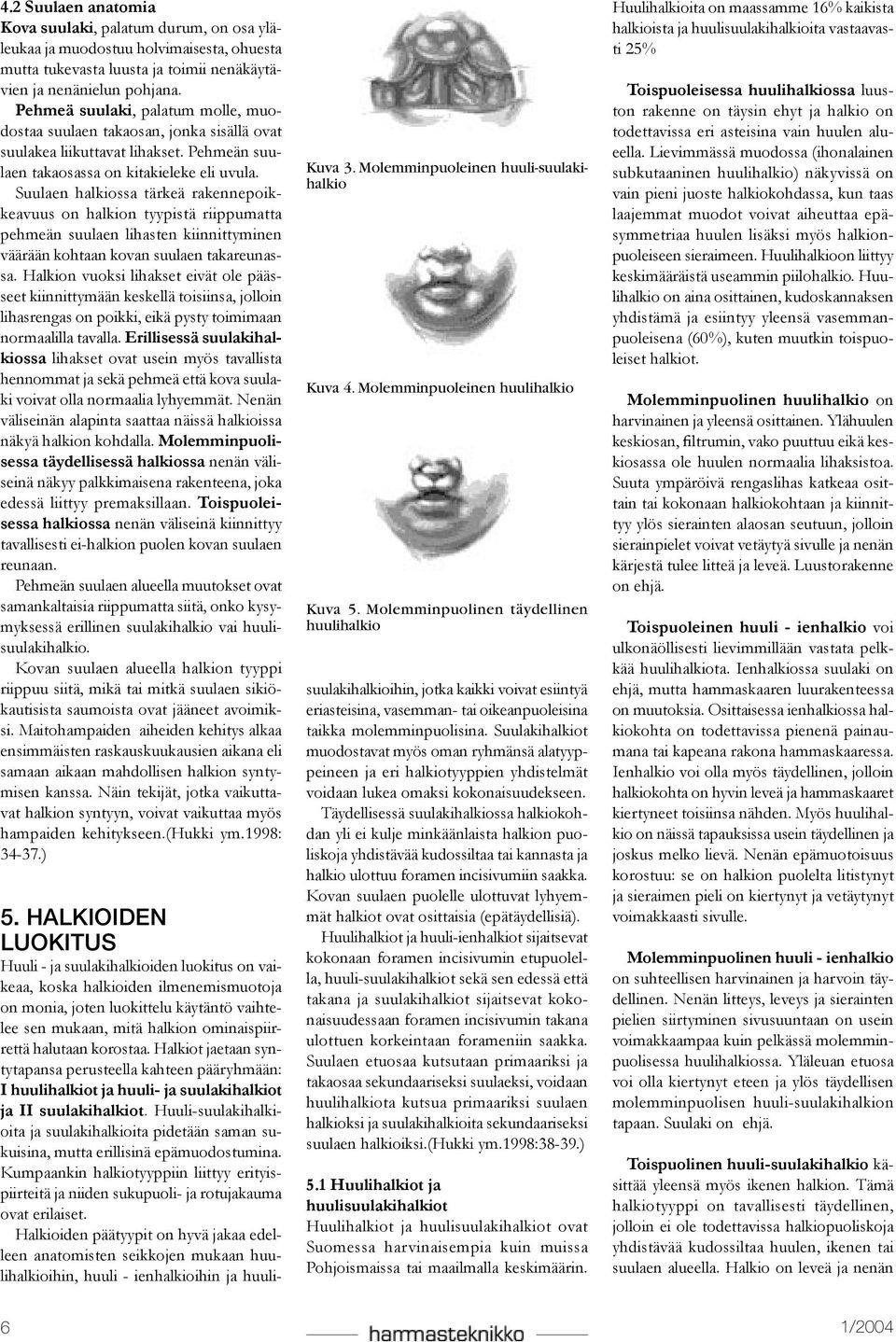 Suulaen halkiossa tärkeä rakennepoikkeavuus on halkion tyypistä riippumatta pehmeän suulaen lihasten kiinnittyminen väärään kohtaan kovan suulaen takareunassa.
