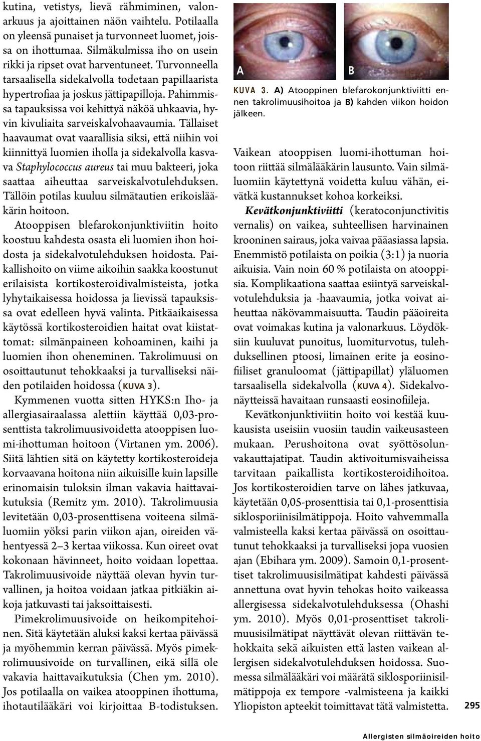 Pahimmissa tapauksissa voi kehittyä näköä uhkaavia, hyvin kivuliaita sarveiskalvohaavaumia.