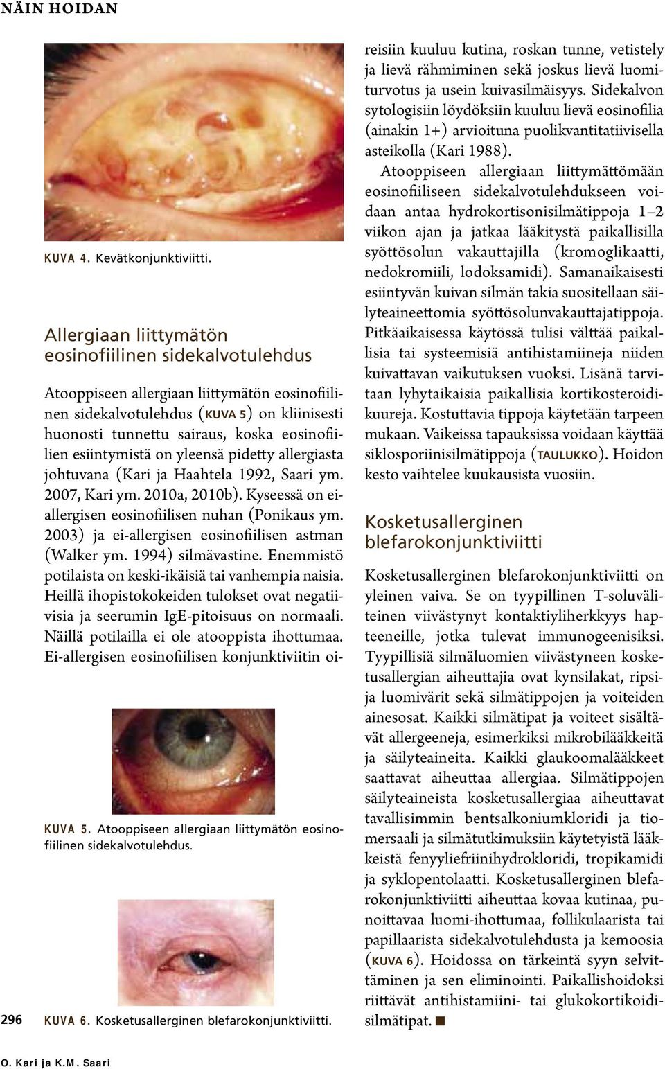 Atooppiseen allergiaan liittymätön eosinofiilinen sidekalvotulehdus (KUVA 5) on kliinisesti huonosti tunnettu sairaus, koska eosinofiilien esiintymistä on yleensä pidetty allergiasta johtuvana (Kari