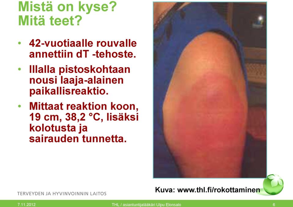 Mittaat reaktion koon, 19 cm, 38,2 C, lisäksi kolotusta ja sairauden
