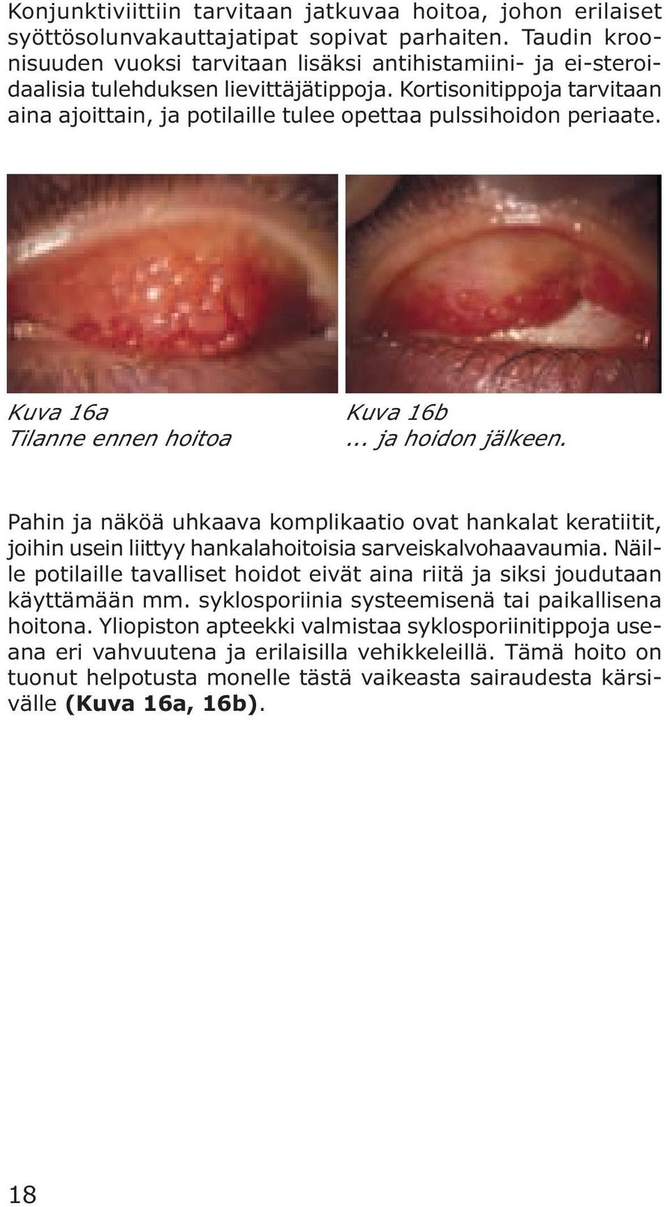 Kortisonitippoja tarvitaan aina ajoittain, ja potilaille tulee opettaa pulssihoidon periaate. Kuva 16a Tilanne ennen hoitoa Kuva 16b... ja hoidon jälkeen.