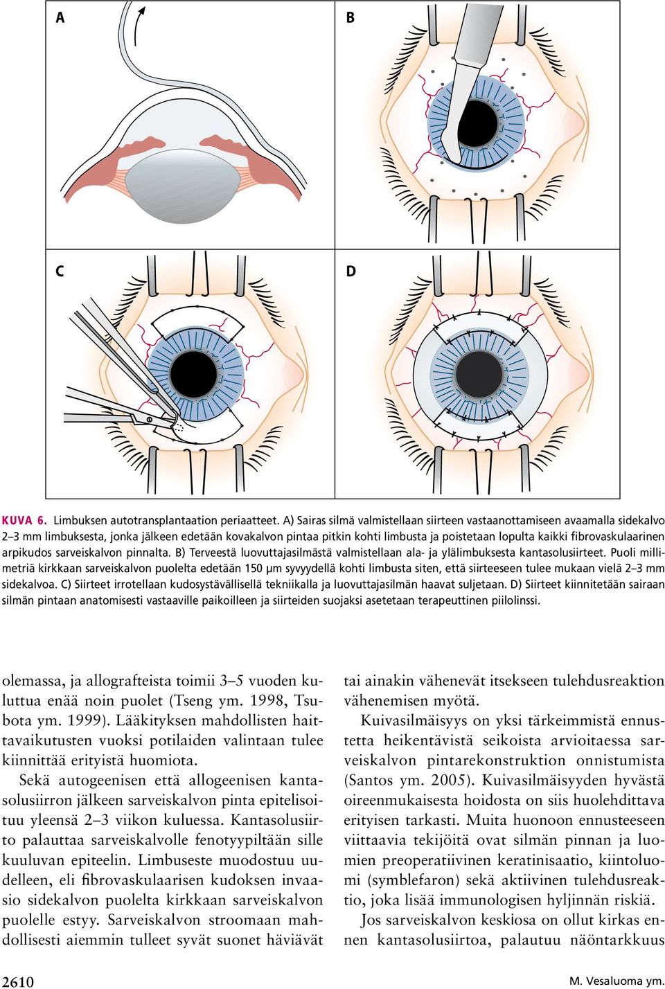 fibrovaskulaarinen arpikudos sarveiskalvon pinnalta. B) Terveestä luovuttajasilmästä valmistellaan ala- ja ylälimbuksesta kantasolusiirteet.