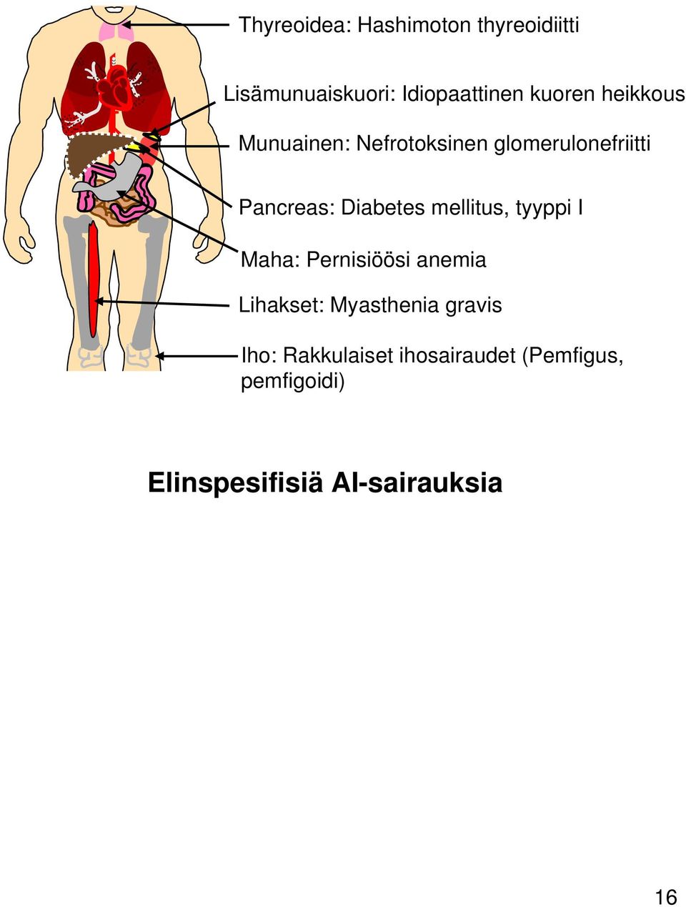 mellits, tyyppi I Maha: Pernisiöösi anemia Lihakset: Myasthenia gravis