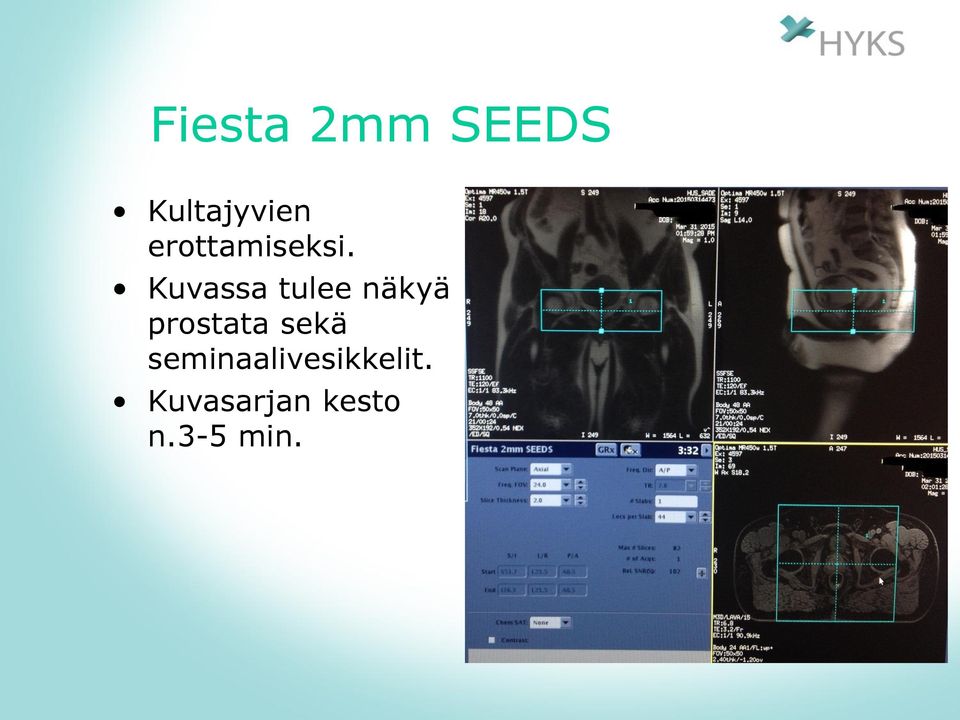 Kuvassa tulee näkyä prostata