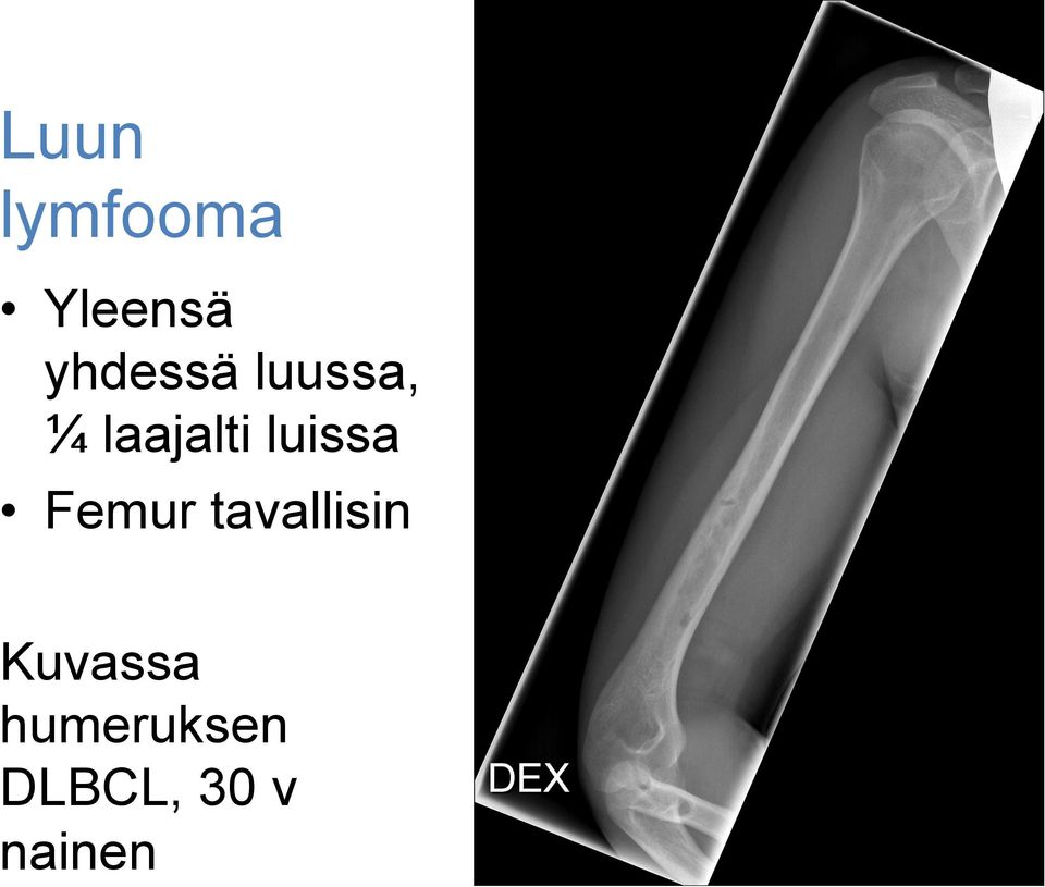 luissa Femur tavallisin