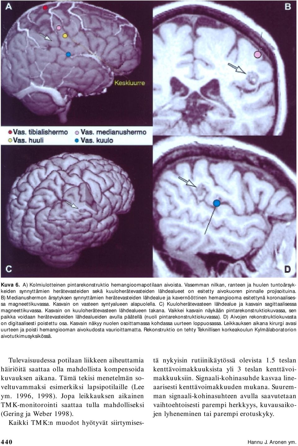 B) Medianushermon ärsytyksen synnyttämien herätevasteiden lähdealue ja kavernööttinen hemangiooma esitettynä koronaalisessa magneettikuvassa. Kasvain on vasteen syntyalueen alapuolella.