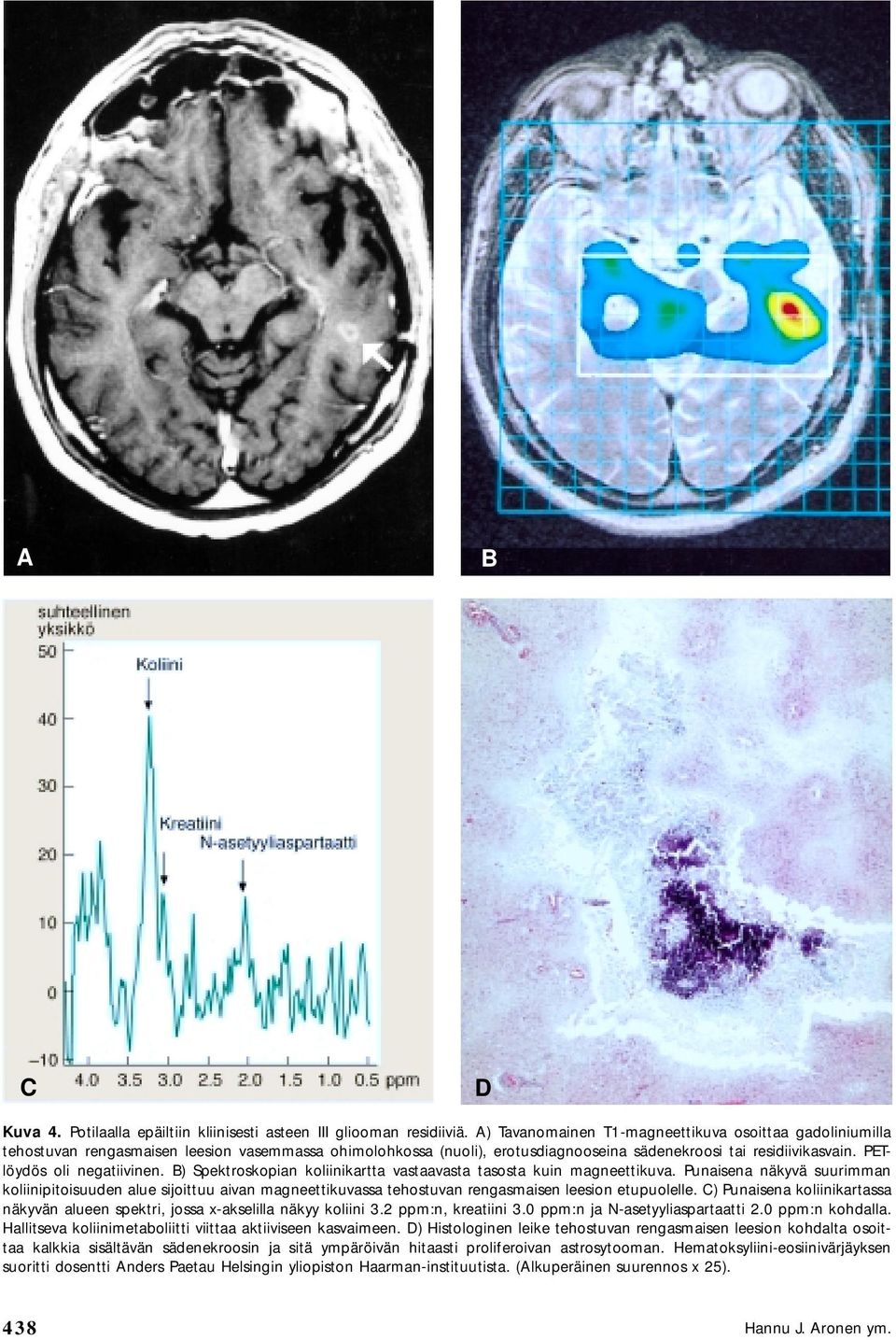 PETlöydös oli negatiivinen. B) Spektroskopian koliinikartta vastaavasta tasosta kuin magneettikuva.