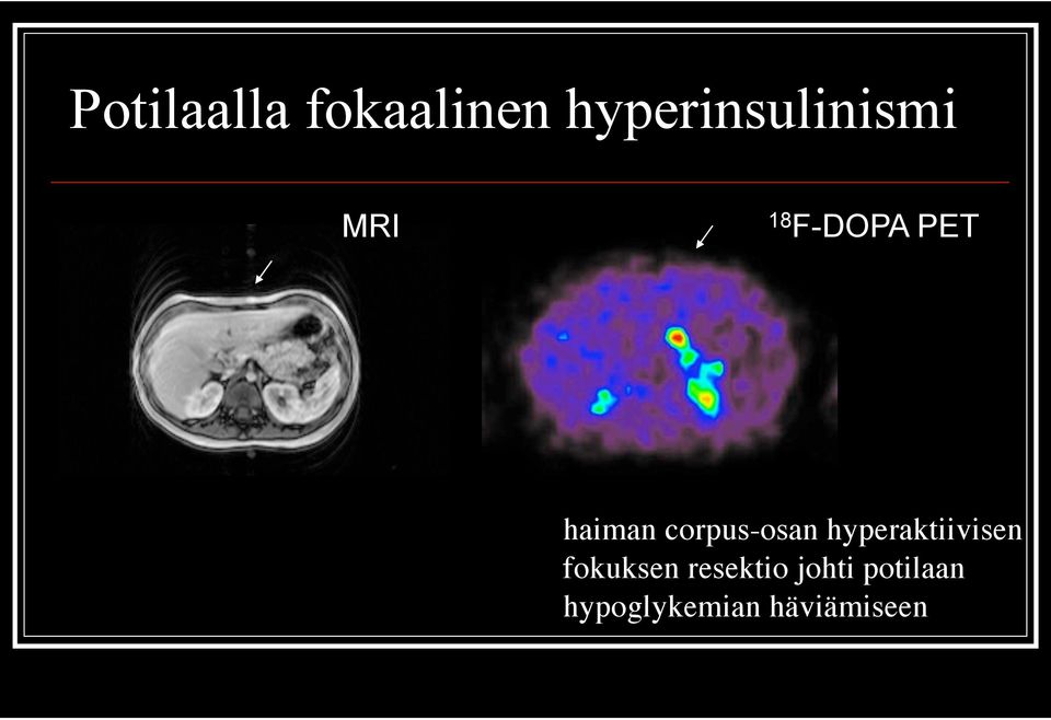 haiman corpus-osan hyperaktiivisen