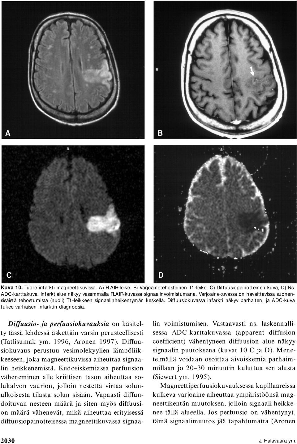 Diffuusiokuvassa infarkti näkyy parhaiten, ja ADC-kuva tukee varhaisen infarktin diagnoosia.