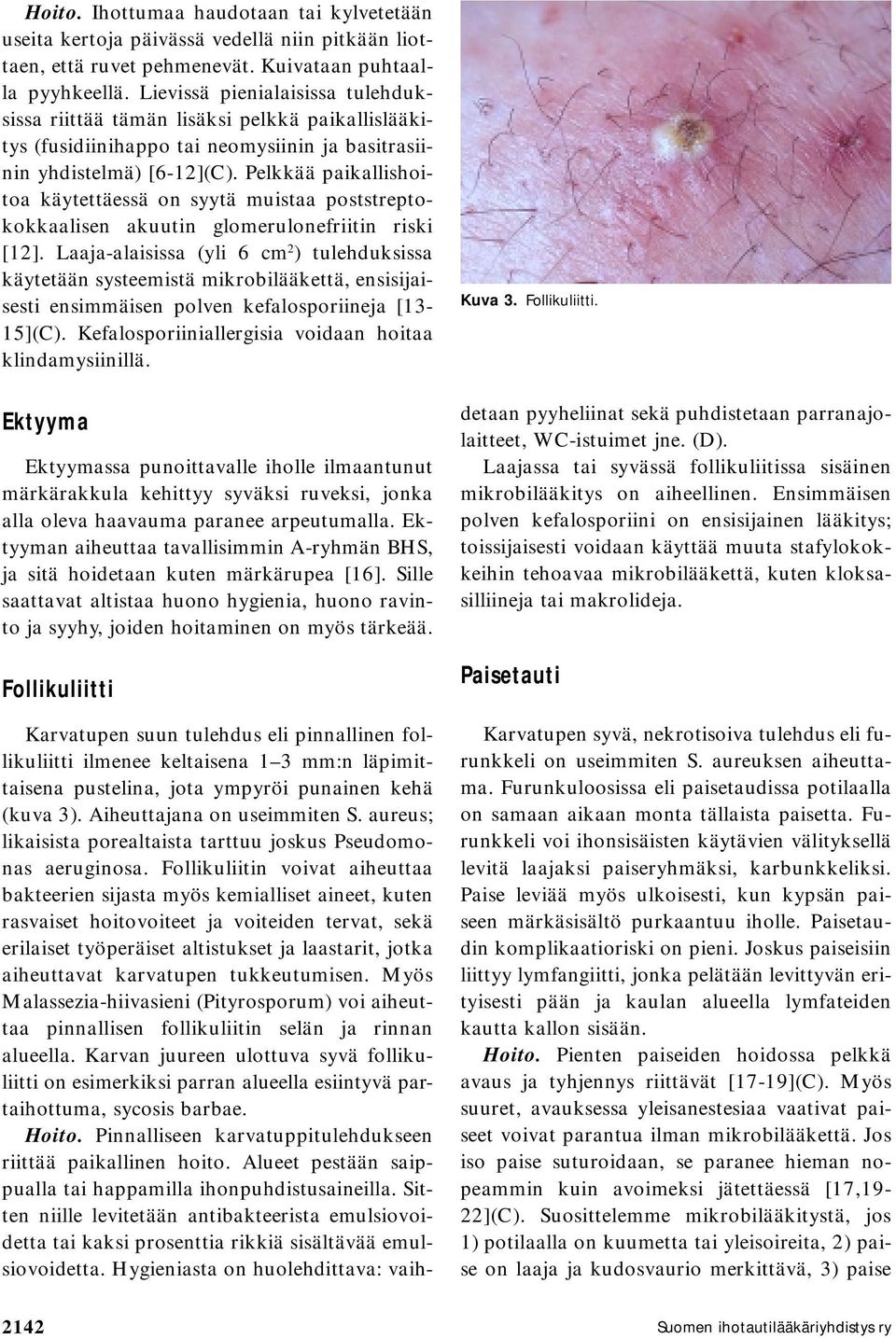 Pelkkää paikallishoitoa käytettäessä on syytä muistaa poststreptokokkaalisen akuutin glomerulonefriitin riski [12].