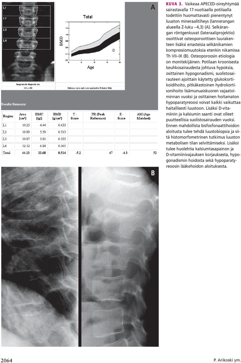 Osteoporoosin etiologia on monitekijäinen.