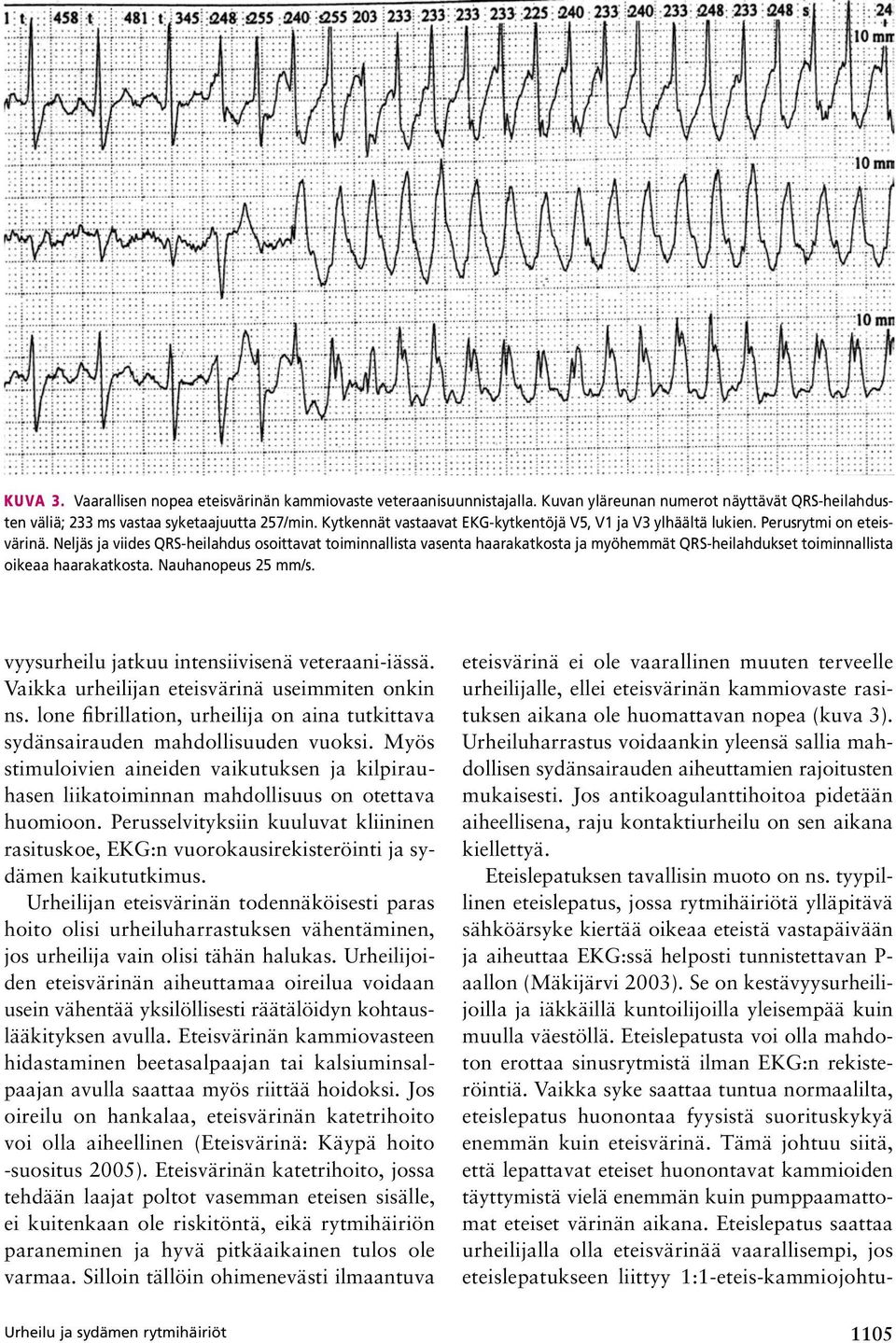 Neljäs ja viides QRS-heilahdus osoittavat toiminnallista vasenta haarakatkosta ja myöhemmät QRS-heilahdukset toiminnallista oikeaa haarakatkosta. Nauhanopeus 25 mm/s.