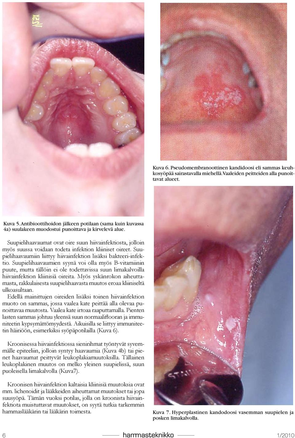 Suupielihaavaumat ovat oire suun hiivainfektiosta, jolloin myös suussa voidaan todeta infektion kliiniset oireet. Suupielihaavaumiin liittyy hiivainfektion lisäksi bakteeri-infektio.