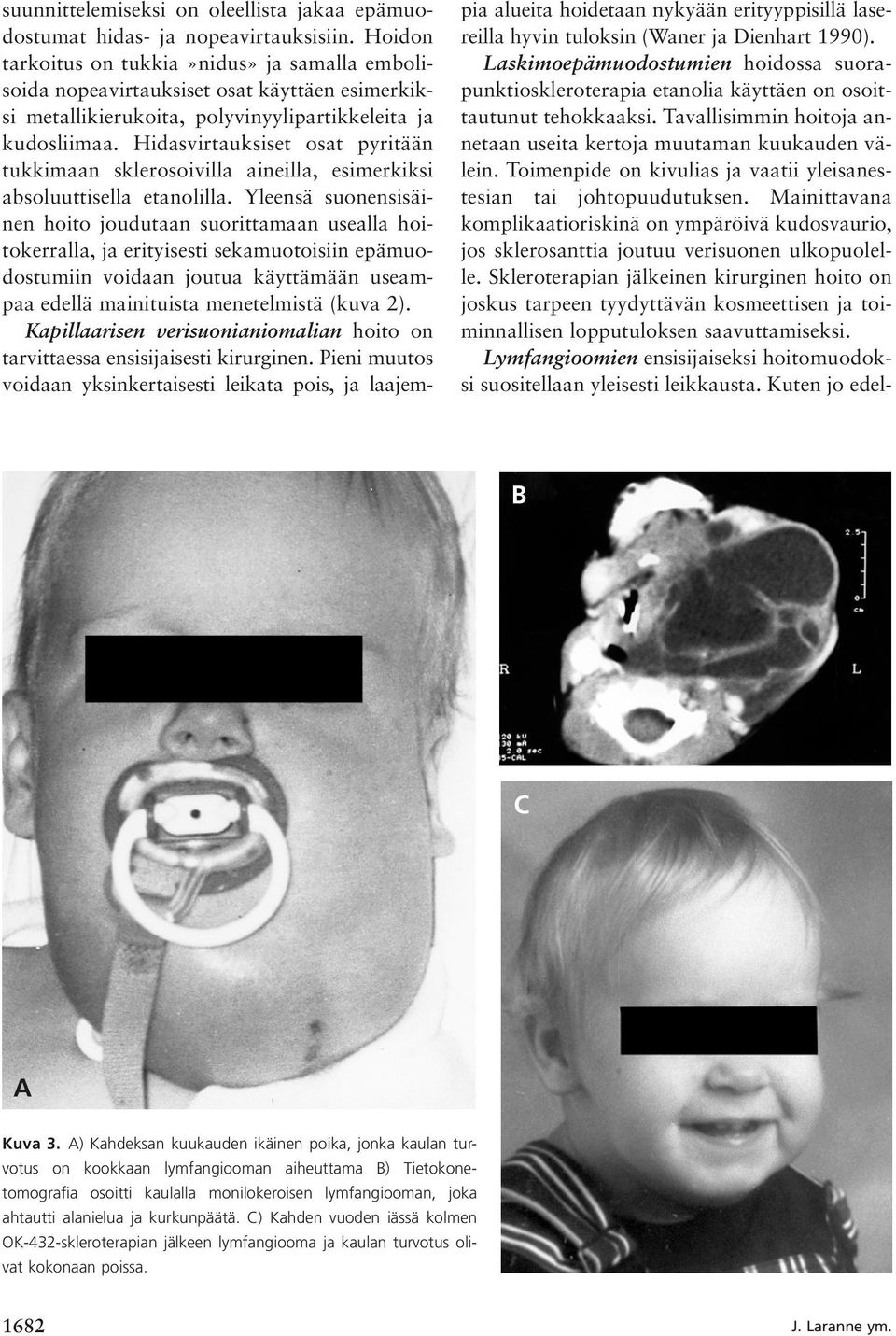 Hidasvirtauksiset osat pyritään tukkimaan sklerosoivilla aineilla, esimerkiksi absoluuttisella etanolilla.