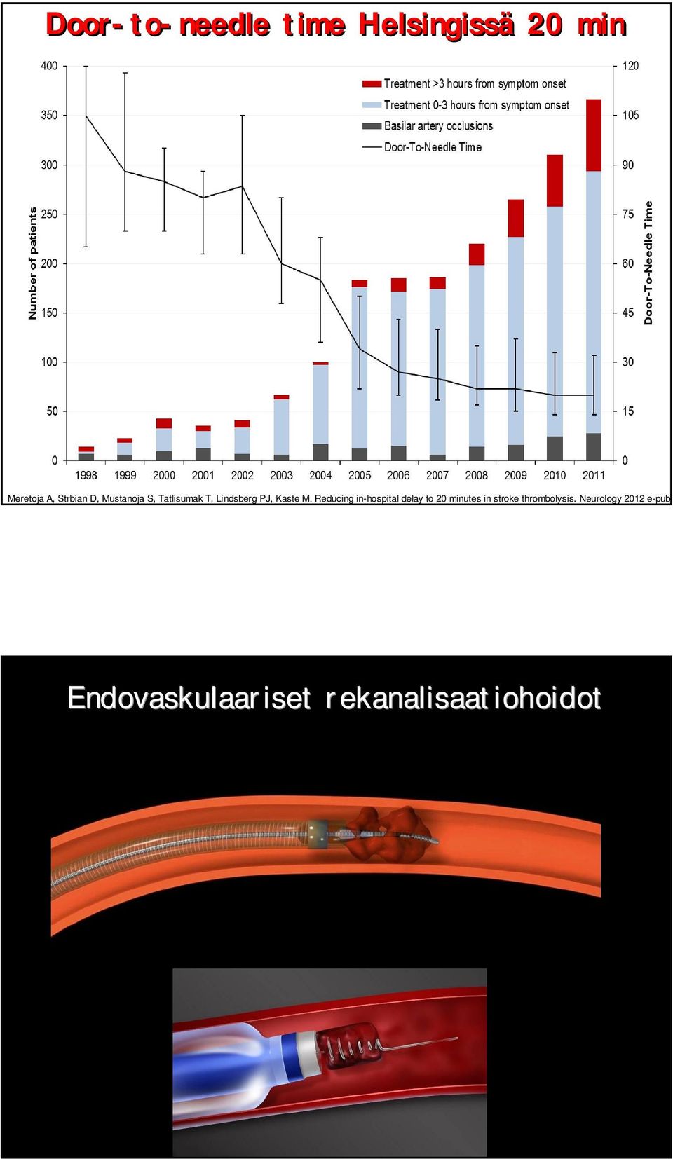 Reducing in-hospital delay to 20 minutes in stroke