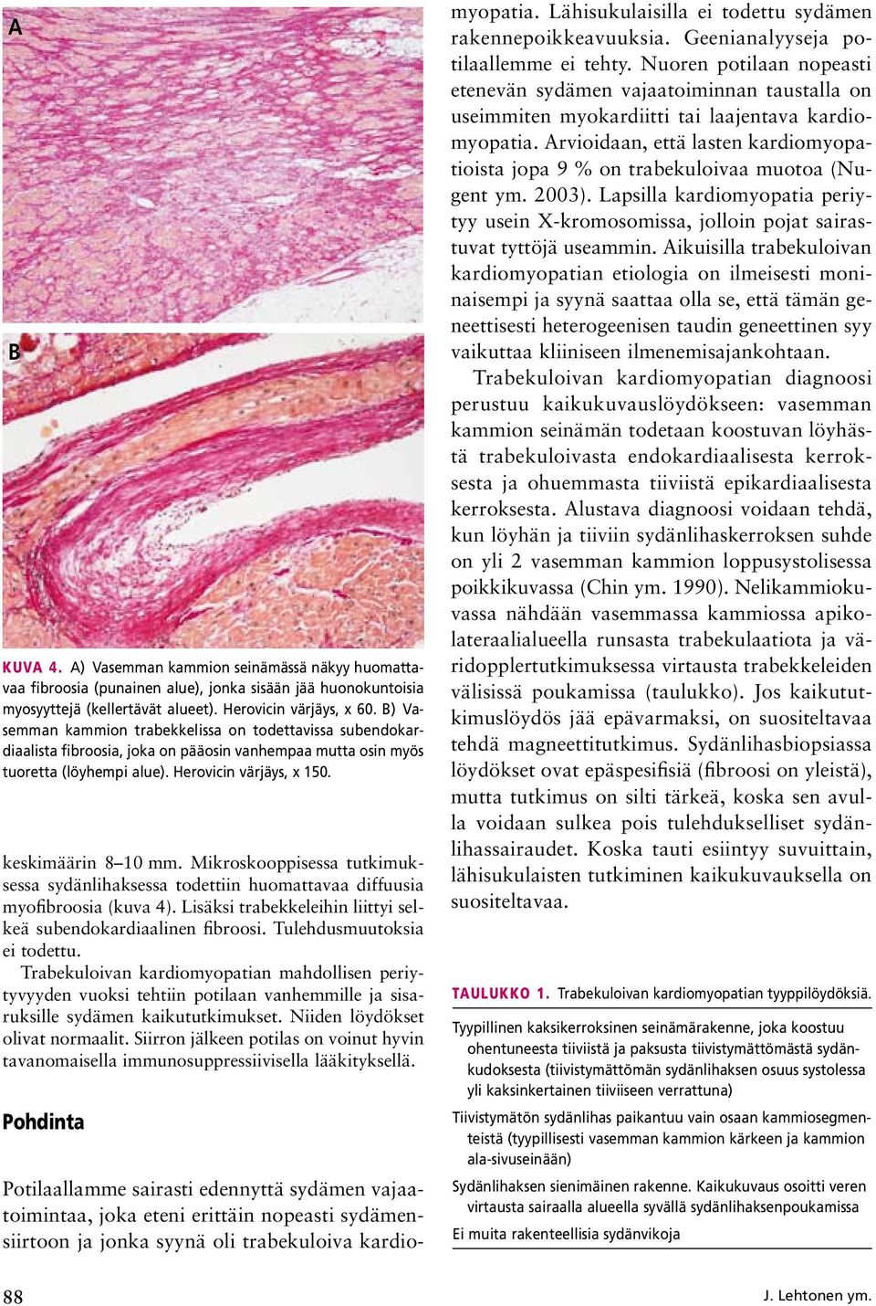 Mikroskooppisessa tutkimuksessa sydänlihaksessa todettiin huomattavaa diffuusia myofibroosia (kuva 4). Lisäksi trabekkeleihin liittyi selkeä subendokardiaalinen fibroosi. Tulehdusmuutoksia ei todettu.