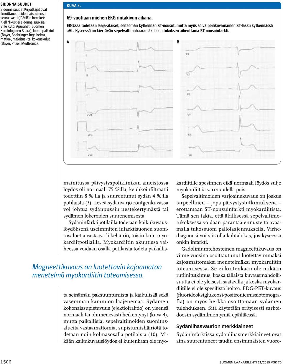 69-vuotiaan miehen EKG rintakivun aikana. EKG:ssa todetaan laaja-alaiset, seitsemän kytkennän ST-nousut, mutta myös selvä peilikuvamainen ST-lasku kytkennässä avl.