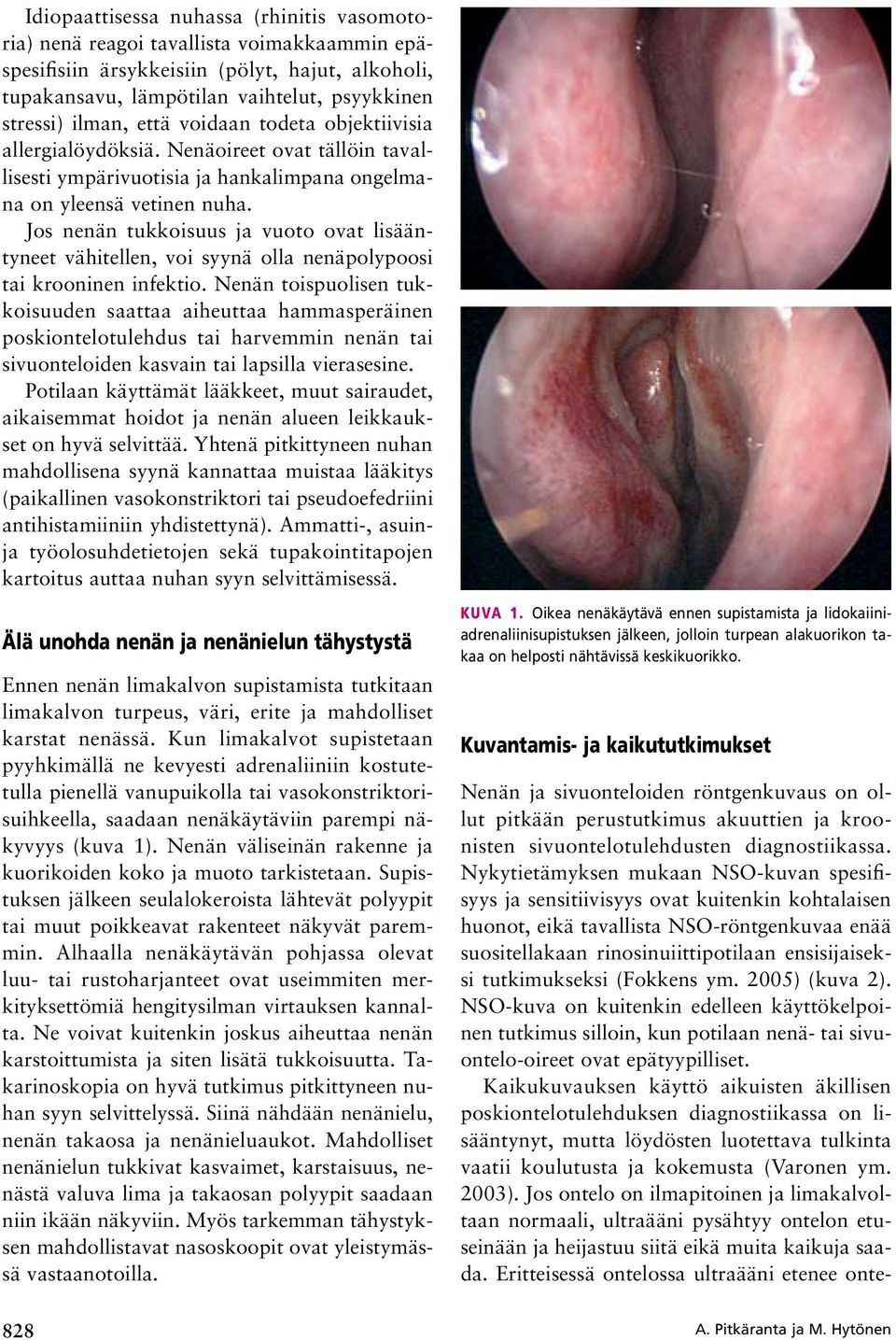 Jos nenän tukkoisuus ja vuoto ovat lisääntyneet vähitellen, voi syynä olla nenäpolypoosi tai krooninen infektio.