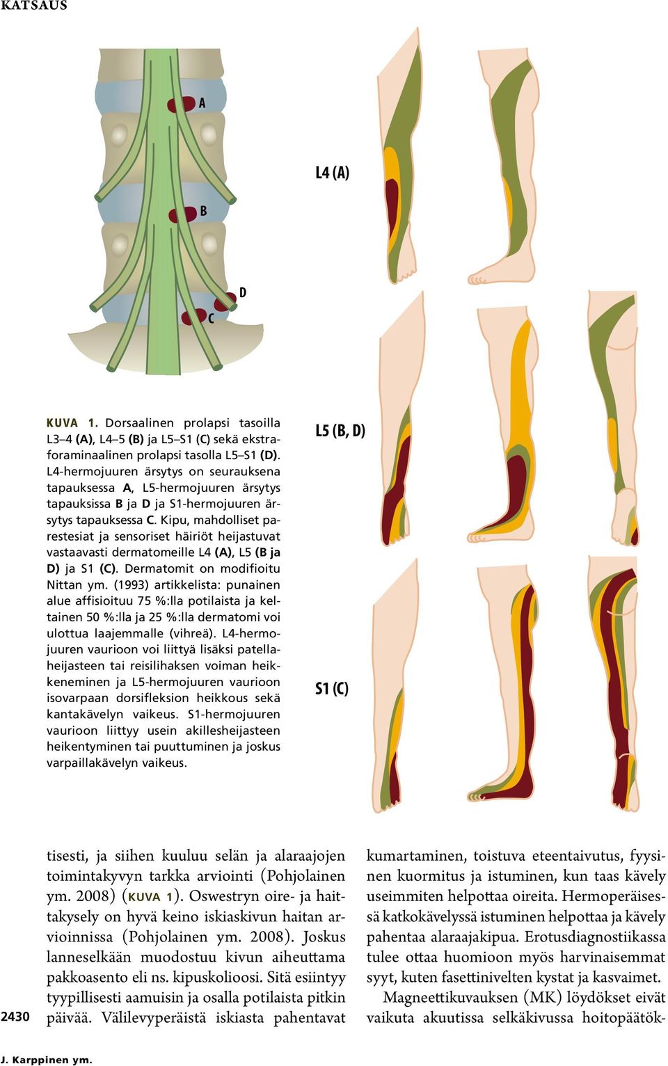 Kipu, mahdolliset parestesiat ja sensoriset häiriöt heijastuvat vastaavasti dermatomeille L4 (A), L5 (B ja D) ja S1 (C). Dermatomit on modifioitu Nittan ym.