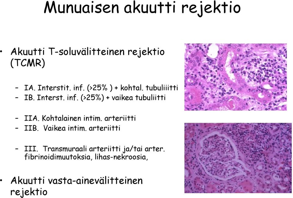 Kohtalainen intim. arteriitti IIB. Vaikea intim. arteriitti III.