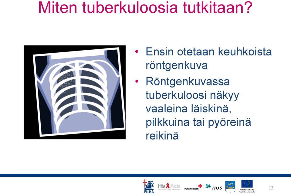 Röntgenkuvassa tuberkuloosi näkyy