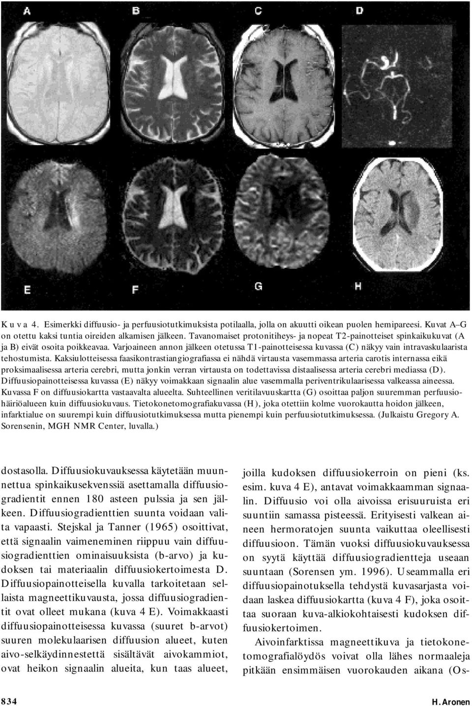 Varjoaineen annon jälkeen otetussa T1-painotteisessa kuvassa (C) näkyy vain intravaskulaarista tehostumista.