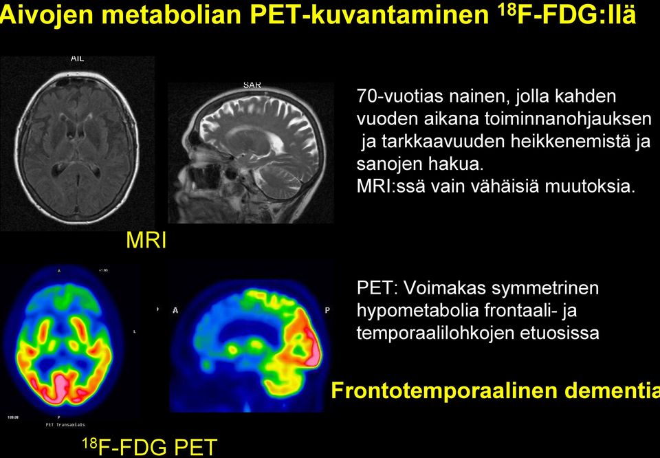 sanojen hakua. MRI:ssä vain vähäisiä muutoksia.